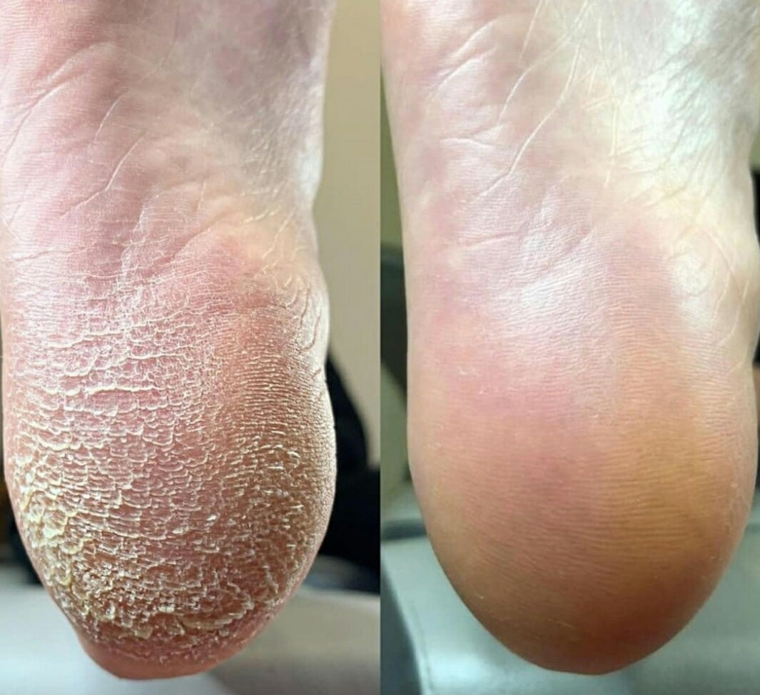 Lisa Kon – Crema para pies – Crema para pies con 5% o 15% de urea para pies secos y agrietados, talones, rodillas, codos, tratamiento reparador, humectante suavizante para pies