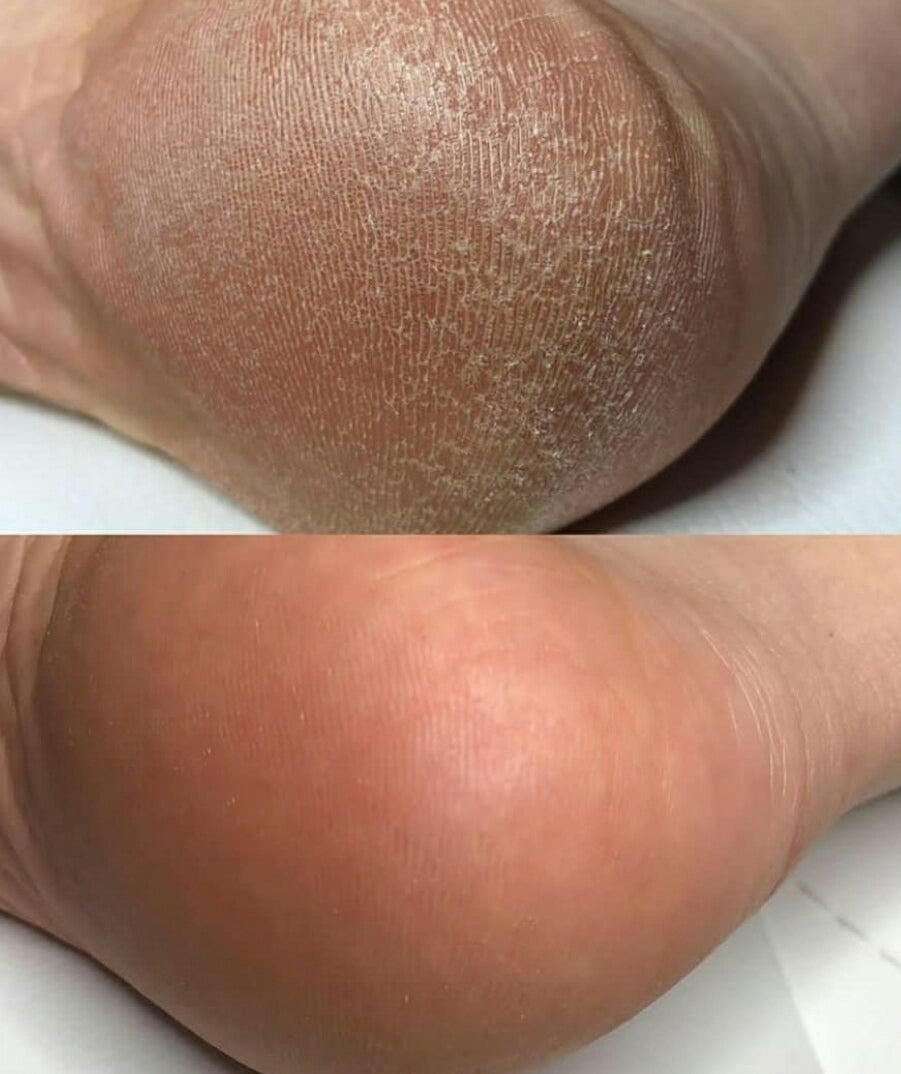 Lisa Kon – Foot Cream – 5% or 15% Urea Foot Cream for Dry Cracked Feet Heels Knees Elbows Repair Treatment, Moisturizer Softener for Feet