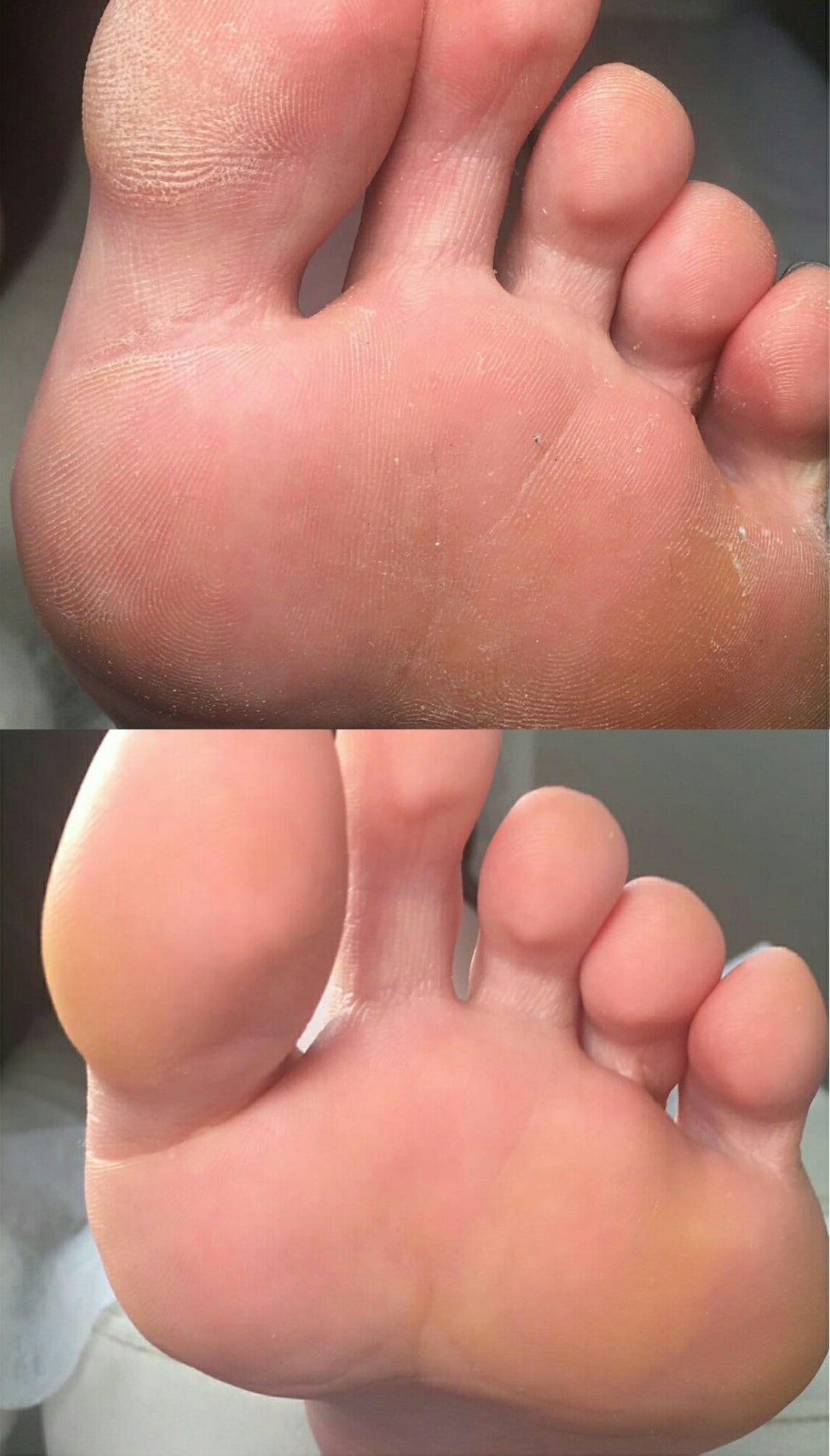 Lisa Kon – Foot Cream – 5% or 15% Urea Foot Cream for Dry Cracked Feet Heels Knees Elbows Repair Treatment, Moisturizer Softener for Feet